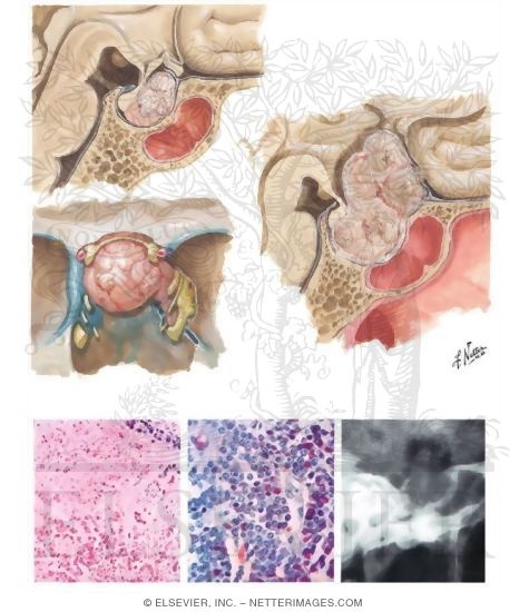 Acidophil Adenoma
