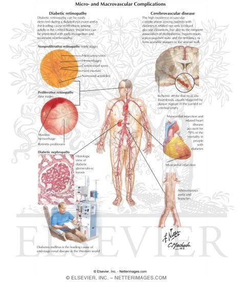 Diabetes Mellitus and Its Complications: Micro and Macrovascular Complications