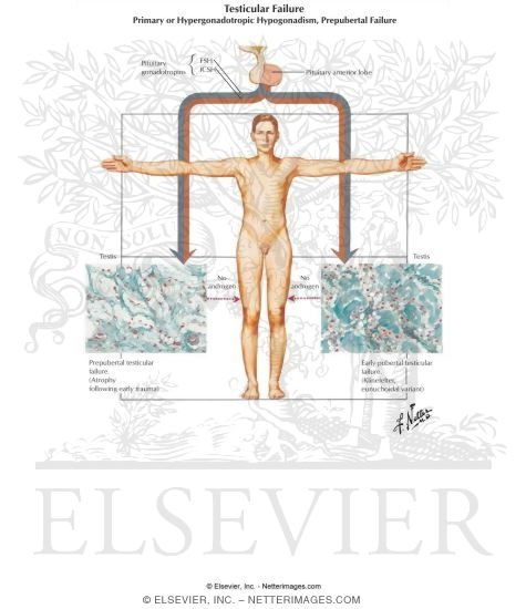 Testicular Failure - Primary Or Hypergonadotropic Hypogonadism, Prepubertal Failure