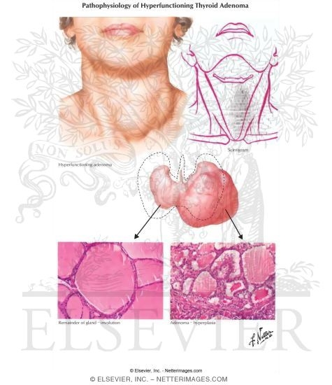 Pathophysiology of Toxic Adenoma and Toxic Multinodular Goiter