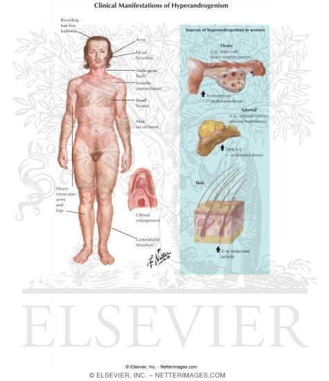 Watermarked preview of labeled image: Clinical Manifestations of Hyperandrogenism