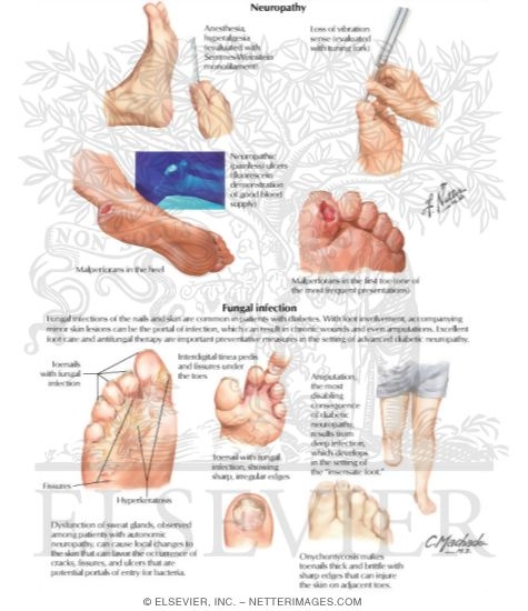 Diabetes Mellitus and Its Complications: Neuropathy and Fungal Infection
