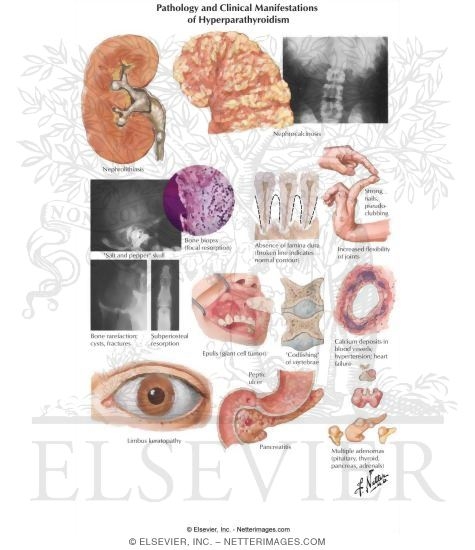 Watermarked preview of labeled image: Pathology and Clinical Manifestations of Hyperparathyroidism