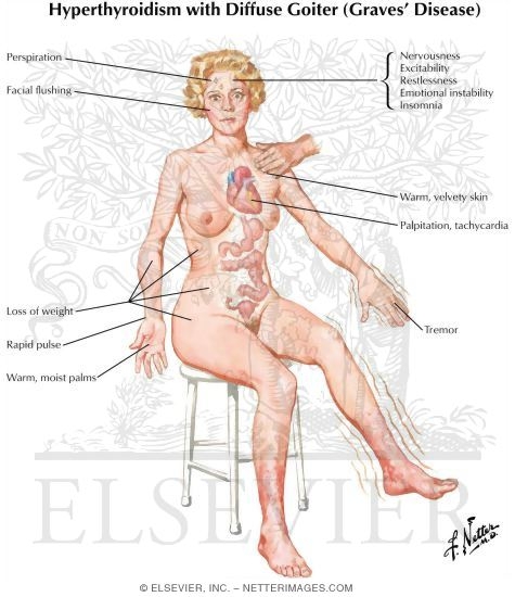 Watermarked preview of labeled image: Hyperthyroidism With Diffuse Goiter (Graves' Disease)