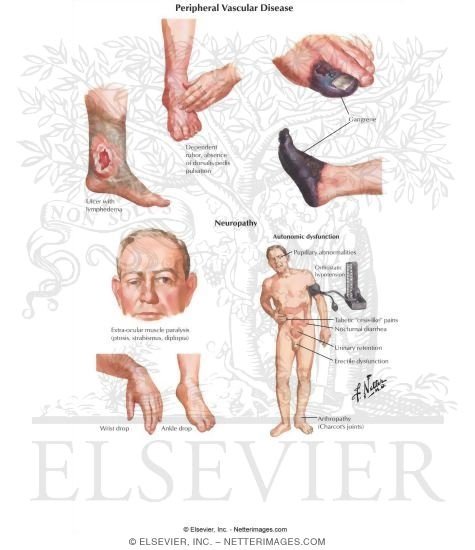 Diabetes Mellitus and Its Complications: Peripheral Vascular Disease