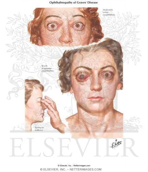 Graves Ophthalmopathy