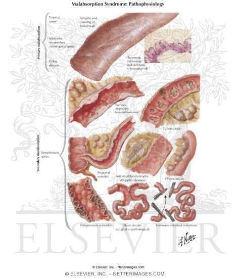Watermarked preview of labeled image: Enterogenous Malabsorption Syndrome (Sprue Syndrome)