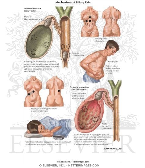 Watermarked preview of labeled image: Mechanisms of Biliary Pain