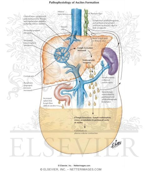 Pathophysiology of Ascites Formation