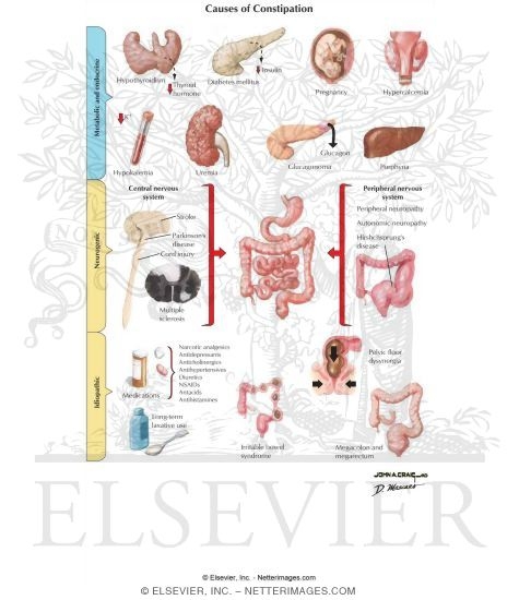 Causes of Constipation