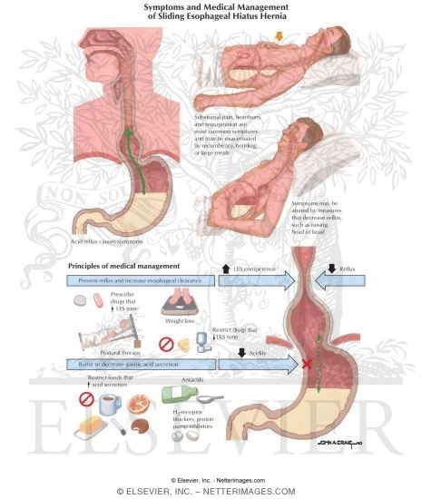 Watermarked preview of labeled image: Symptoms and Medical Management of Sliding Esophageal Hiatus Hernia