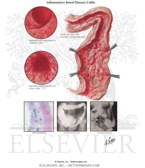 Ulcerative Colitis