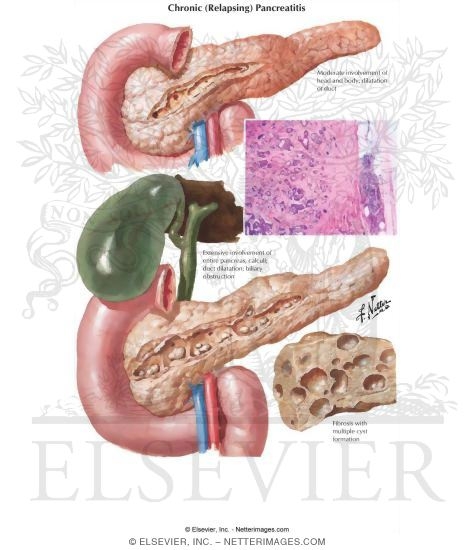 Chronic (Relapsing) Pancreatitis