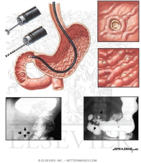 Watermarked preview of unlabeled image: Diagnostic Evaluation of Peptic Ulcer Disease