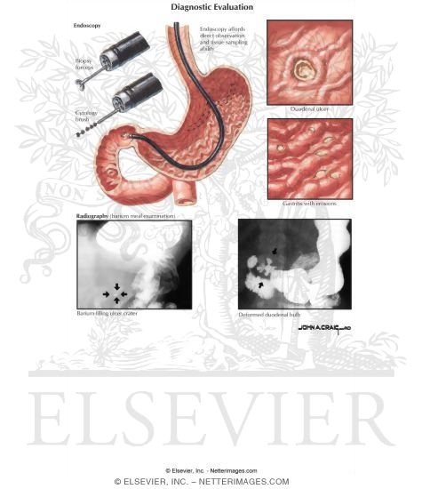 Diagnostic Evaluation of Peptic Ulcer Disease