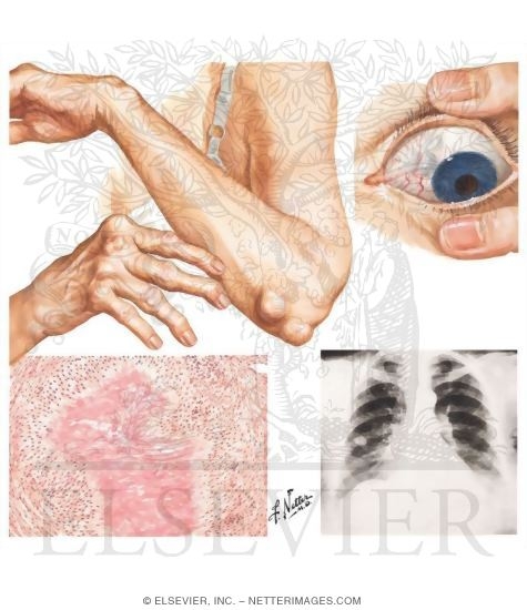 Watermarked preview of unlabeled image: Extraarticular Manifestations In Rheumatoid Arthritis