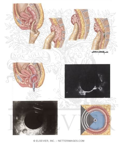 Watermarked preview of unlabeled image: Diagnosis of Rectal Cancer