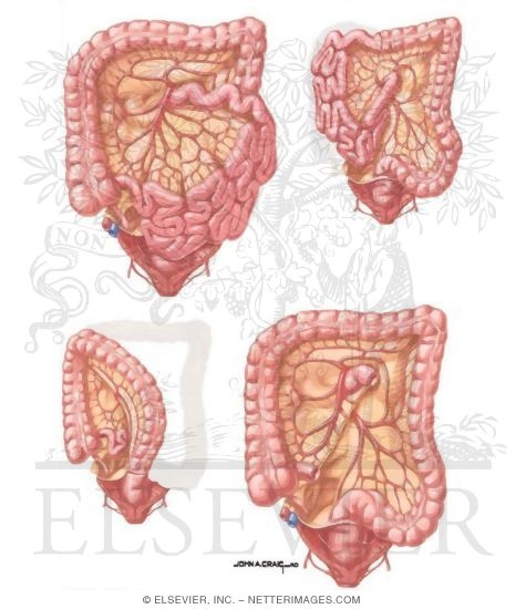 Watermarked preview of unlabeled image: Surgical Resection of Colon Cancer