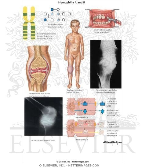 Watermarked preview of labeled image: Hemophilia A and B
