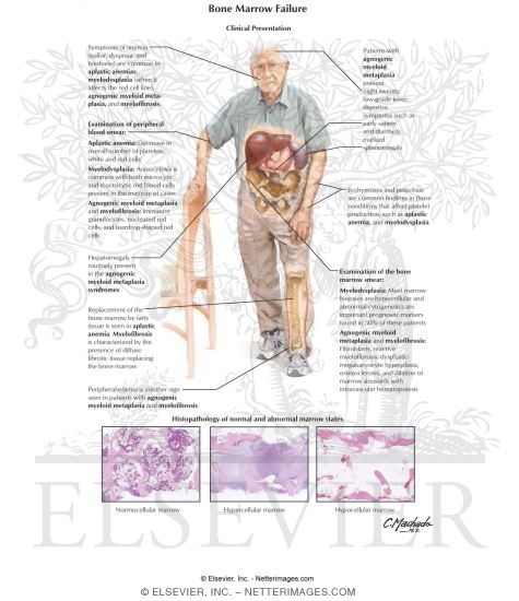 Bone Marrow Failure