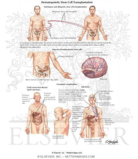 Hematopoietic Stem Cell Transplantation