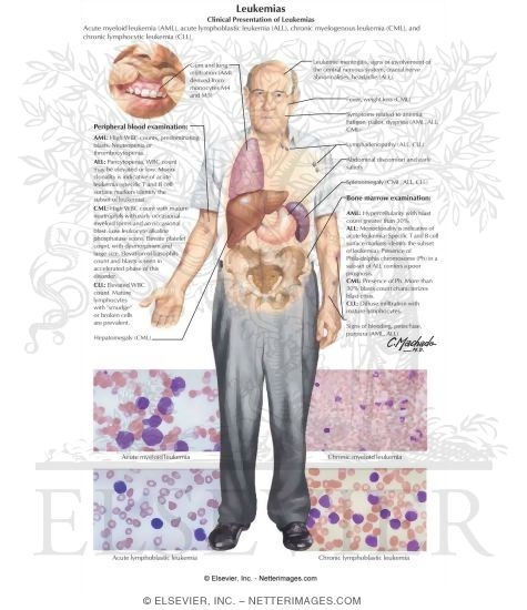 Leukemias