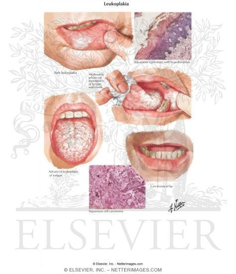 Leukoplakia