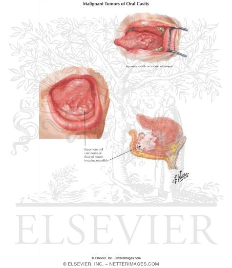Malignant Tumors of Oral Cavity