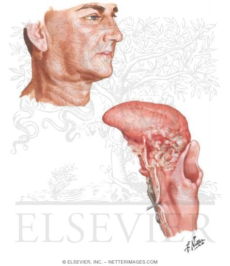 Malignant Tumors of Oropharynx