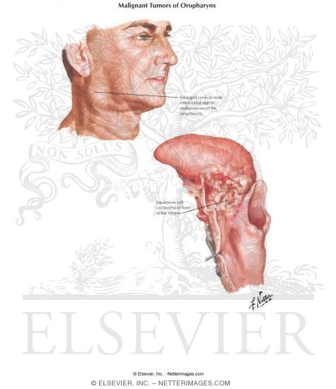 Watermarked preview of labeled image: Malignant Tumors of Oropharynx