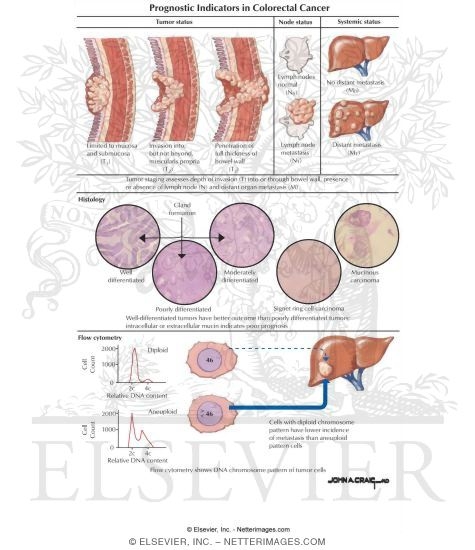 Watermarked preview of labeled image: Prognostic Indicators in Colorectal Cancer