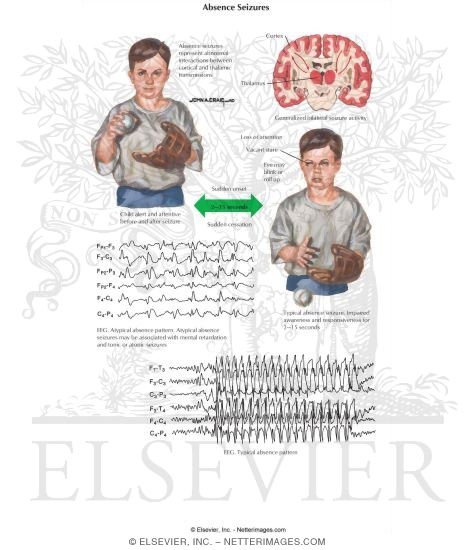 Absence Seizures