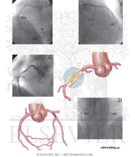 Coronary Angiography