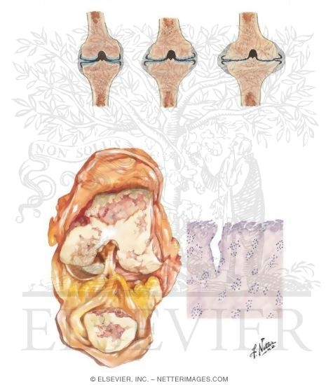 Joint Pathology In Osteoarthritis