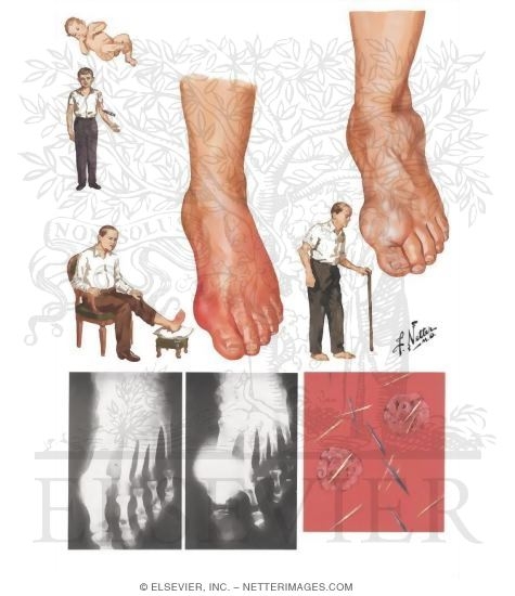 Clinical Aspects of Gout