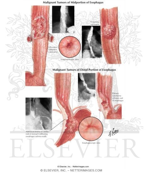 Watermarked preview of labeled image: Malignant Tumors of Midportion and Distal Portion of Esophagus