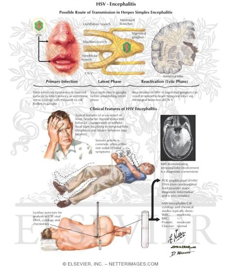 HSV Encephalitis