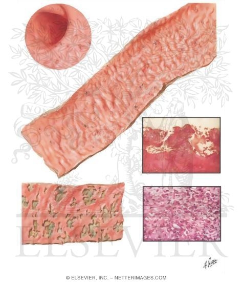 a description of amebiasis 2015-7-18 minocycline hydrochloride capsules, usp rx only to reduce the development of drug-resistant bacteria and maintain the effectiveness of minocycline hydrochloride capsules, usp and other antibacterial drugs, minocycline. a description of amebiasis 2015-7-18 minocycline hydrochloride capsules, usp rx only to reduce the development of drug-resistant bacteria and maintain the effectiveness of minocycline hydrochloride capsules, usp and other antibacterial drugs, minocycline.