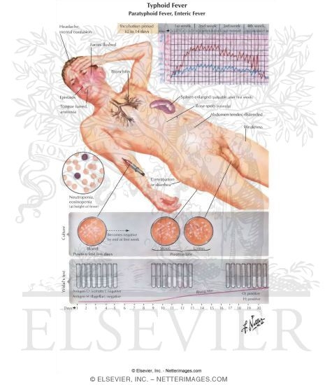 Typhoid Fever