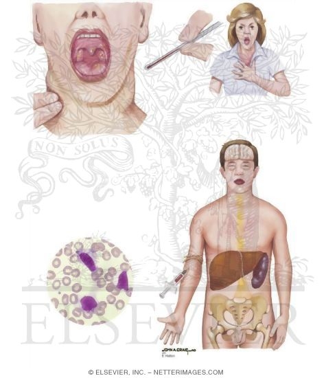 Infectious Mononucleosis