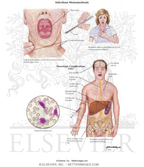 Watermarked preview of labeled image: Infectious Mononucleosis