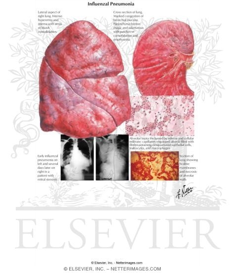 Watermarked preview of labeled image: Influenzal Pneumonia