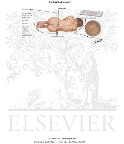 Watermarked preview of labeled image: Bacterial Meningitis