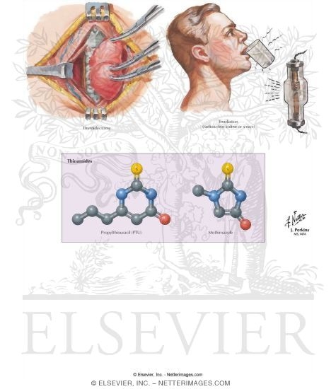 Watermarked preview of labeled image: Hyperthyroidism: Treatment