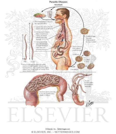 Watermarked preview of labeled image: Parasitic Diseases II - Ascariasis