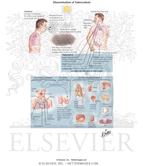 Watermarked preview of labeled image: Dissemination of Tuberculosis