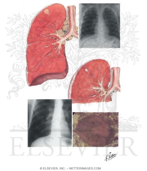 Initial (Primary) Tuberculous Complex