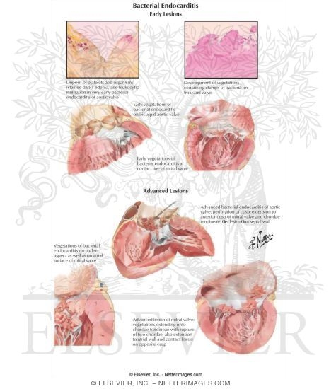 Watermarked preview of labeled image: Bacterial Endocarditis