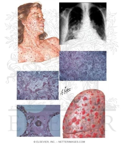 Watermarked preview of unlabeled image: Varicella Pneumonia