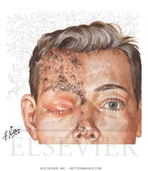 Watermarked preview of unlabeled image: Varicella Zoster With Probable Keratitis